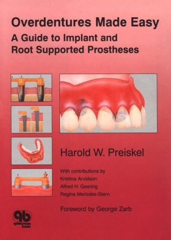 Overdentures made easy
