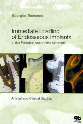 Immediate loading of endosseous implants in the posterior area of the mandible