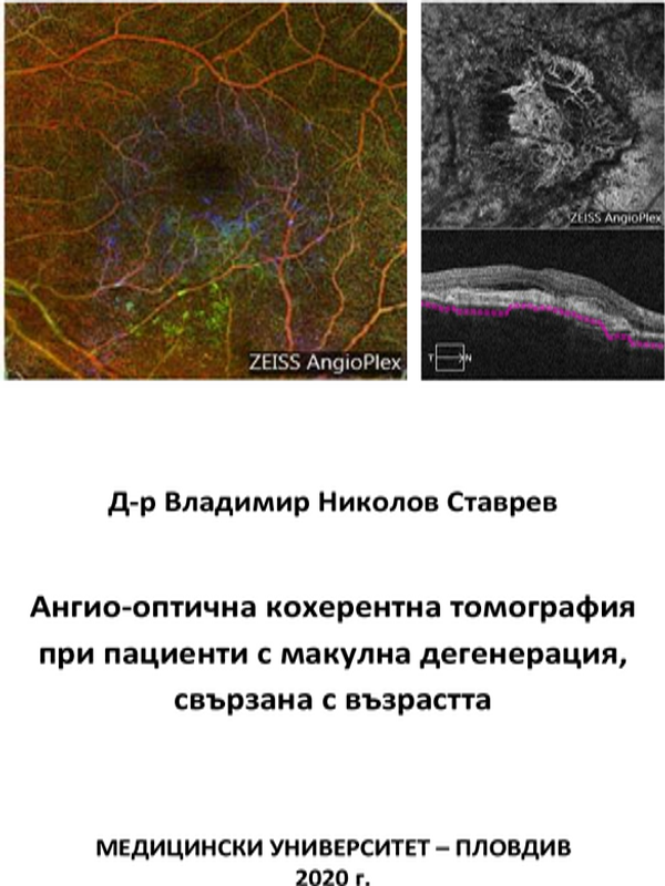 Ангио-оптична кохерентна томография при пациенти с макулна дегенерация, свързана с възрастта