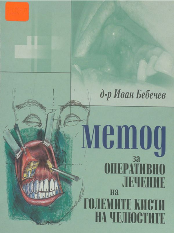 Метод за оперативно лечение на големите кисти на челюстите