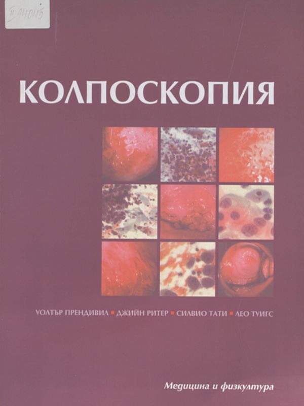 Колпоскопия