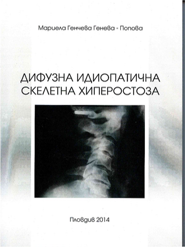 Дифузна идиопатична скелетна хиперостоза