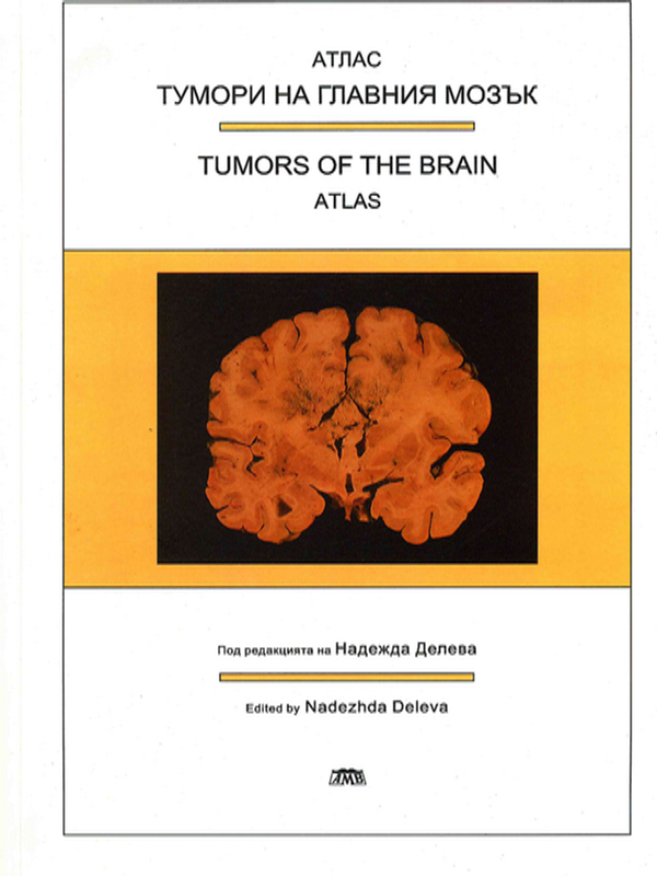 Тумори на главния мозък