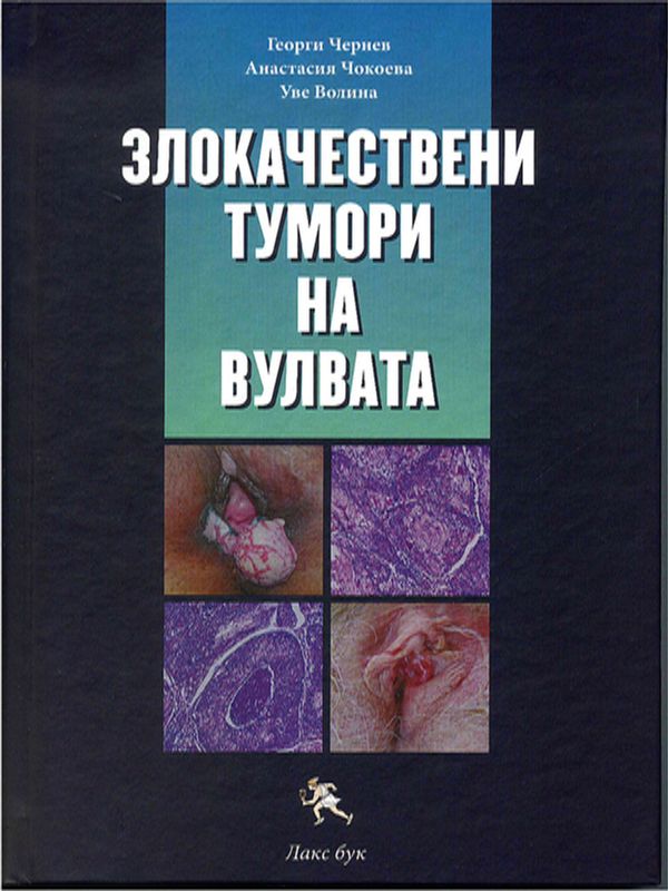 Злокачествени тумори на вулвата