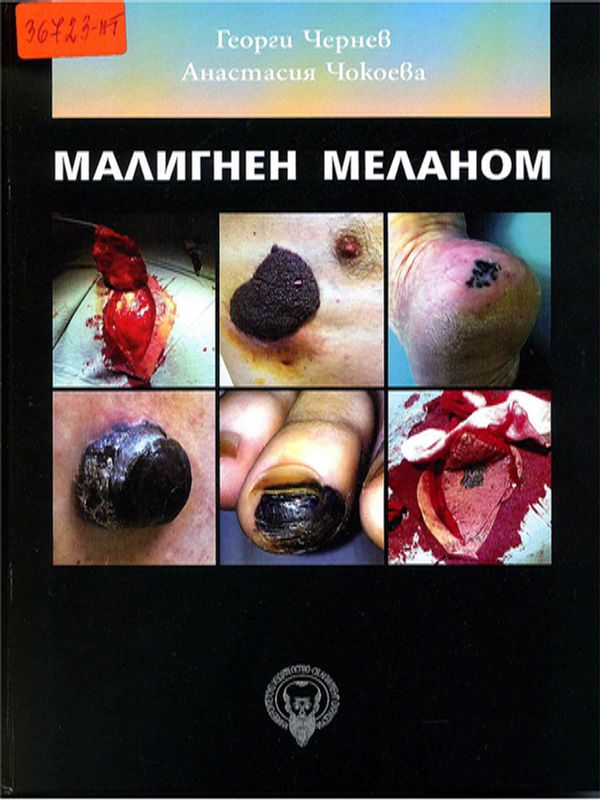 Малигнен меланом