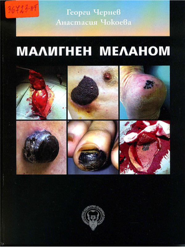 Малигнен меланом