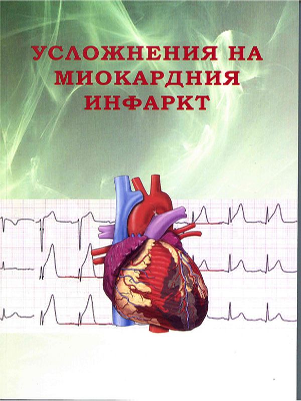 Усложнения на миокардния инфаркт