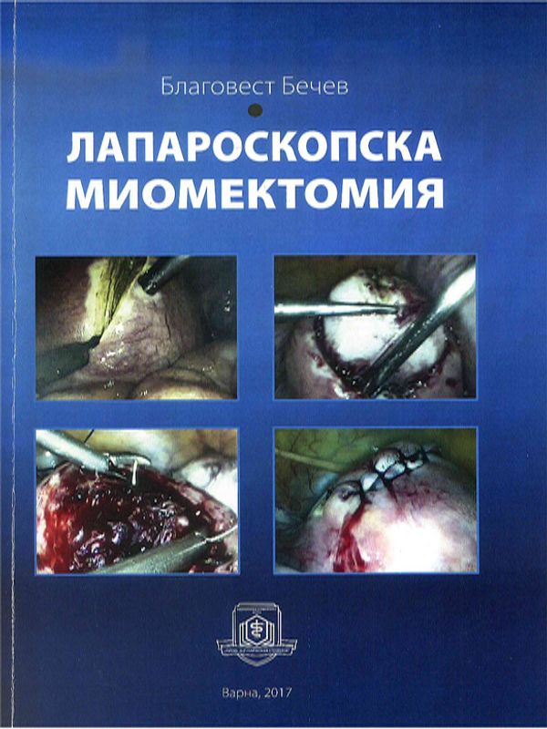 Лапароскопска миомектомия