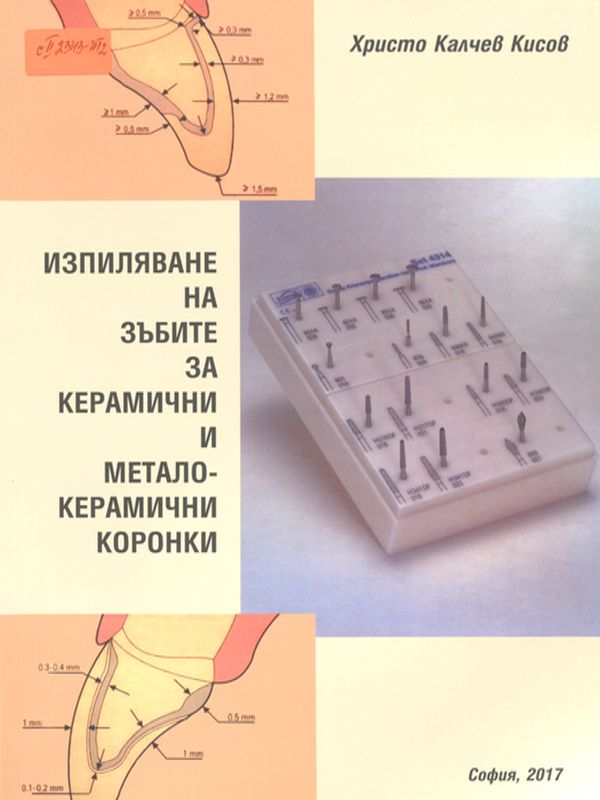 Изпиляване на зъбите за керамични и металокерамични коронки