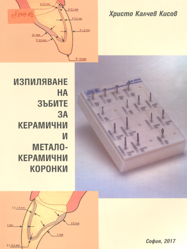 Изпиляване на зъбите за керамични и металокерамични коронки