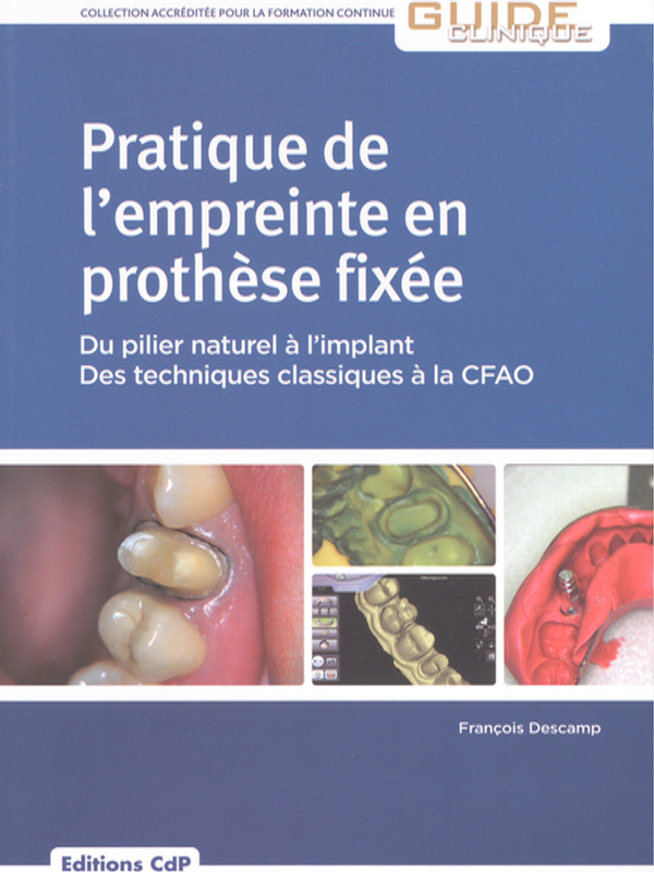 Pratique de l`empreinte en prothese fixee