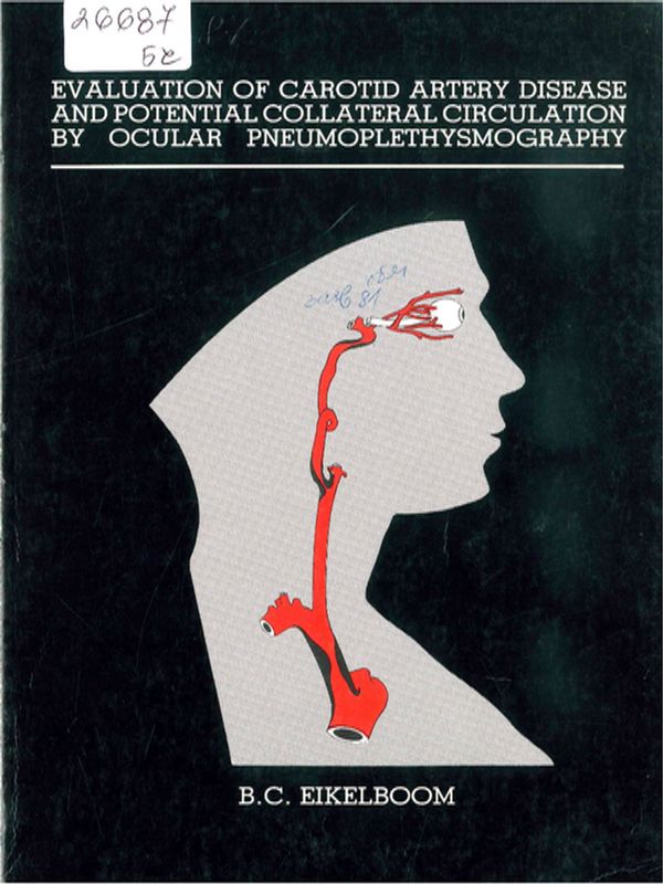 Evaluation of carotid artery disease and potential collateral circulation by ocular pneumoplethysmography