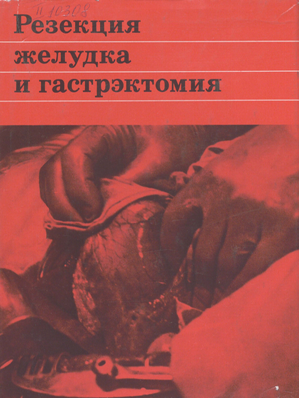 Резекция желудка и гастрэктомия