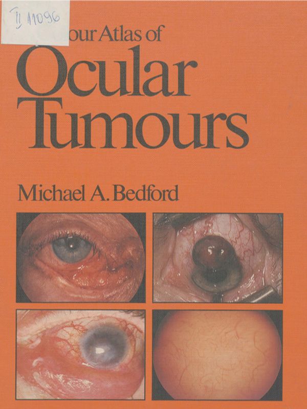 A colour atlas of ocular tumours