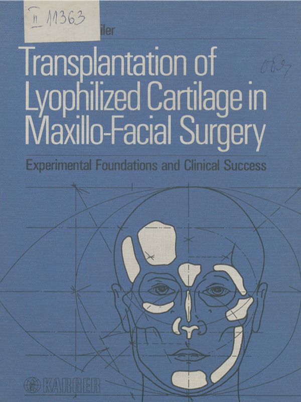 Transplantation of lyophylized cartilage in maxillo-facial surgery