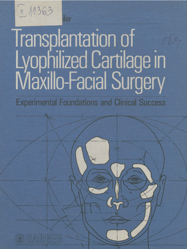 Transplantation of lyophylized cartilage in maxillo-facial surgery