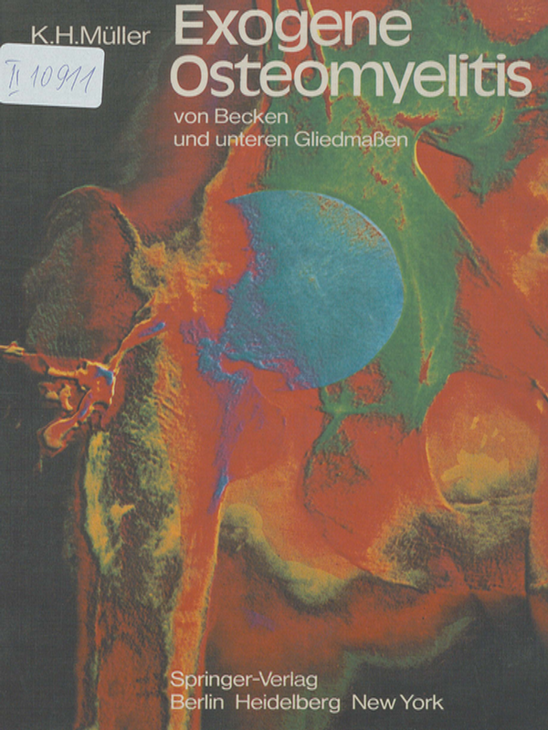 Exogene Ostemyelitis von Becken und unteren Gliedmassen