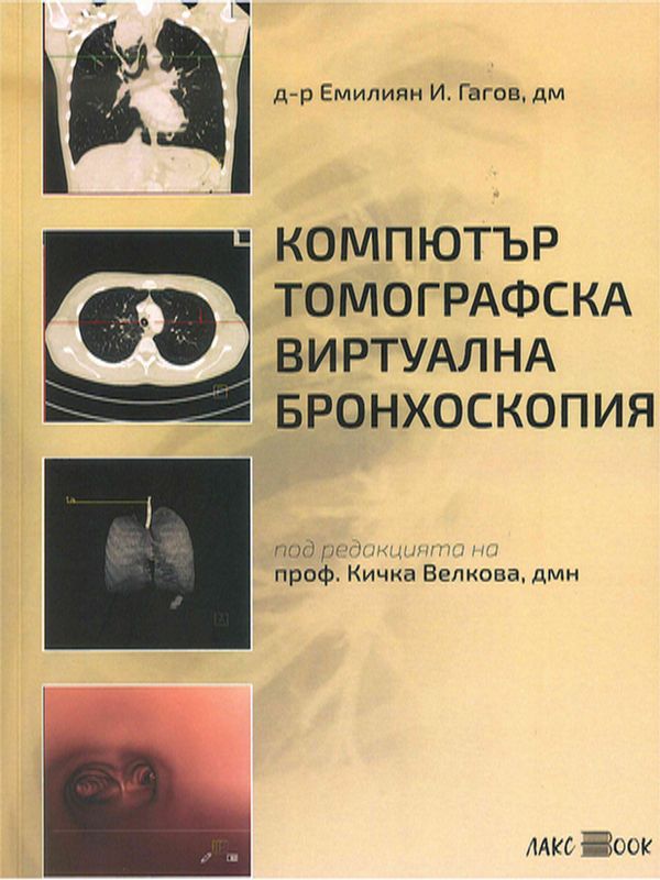 Компютър томографска виртуална бронхоскопия