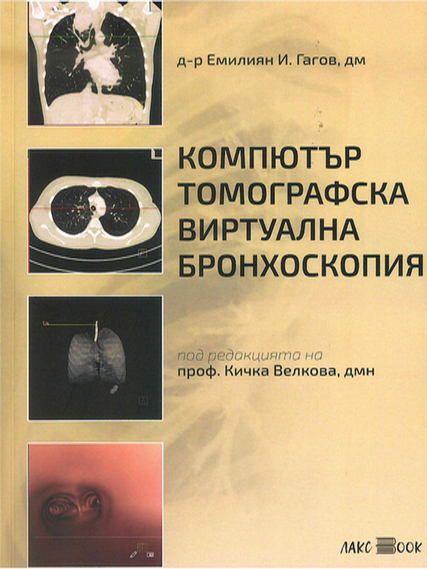 Компютър томографска виртуална бронхоскопия