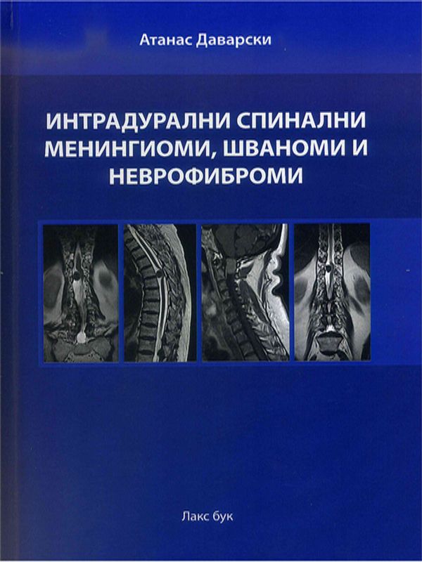 Интрадурални спинални менингиоми, шваноми и неврофиброми