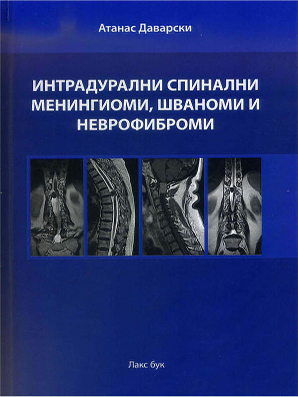 Интрадурални спинални менингиоми, шваноми и неврофиброми