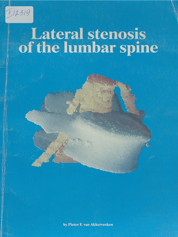 Lateral stenosis of the lumbar spine