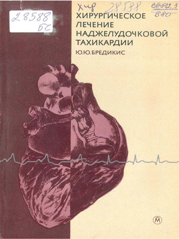 Хирургическое лечение наджелудочковой тахикардии