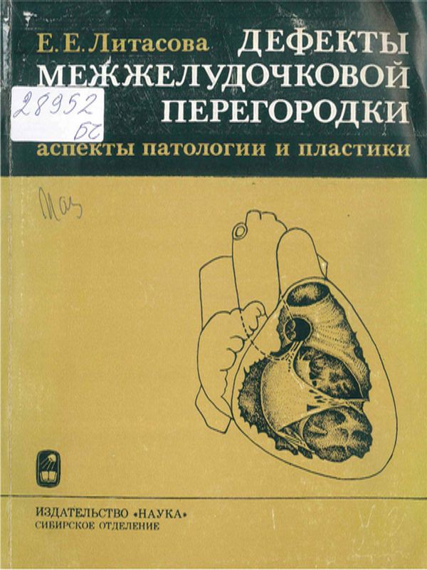 Дефекты межжелудочковой перегородки