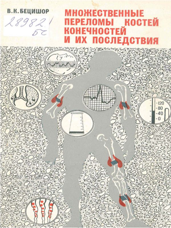 Множественные переломы костей конечностей и их последствия