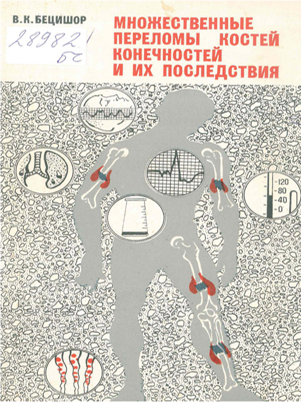 Множественные переломы костей конечностей и их последствия