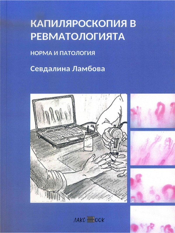 Капиляроскопия в ревматологията