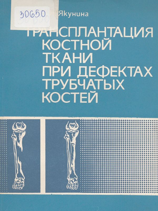 Трансплантация костной ткани при дефектах трубчатых костей