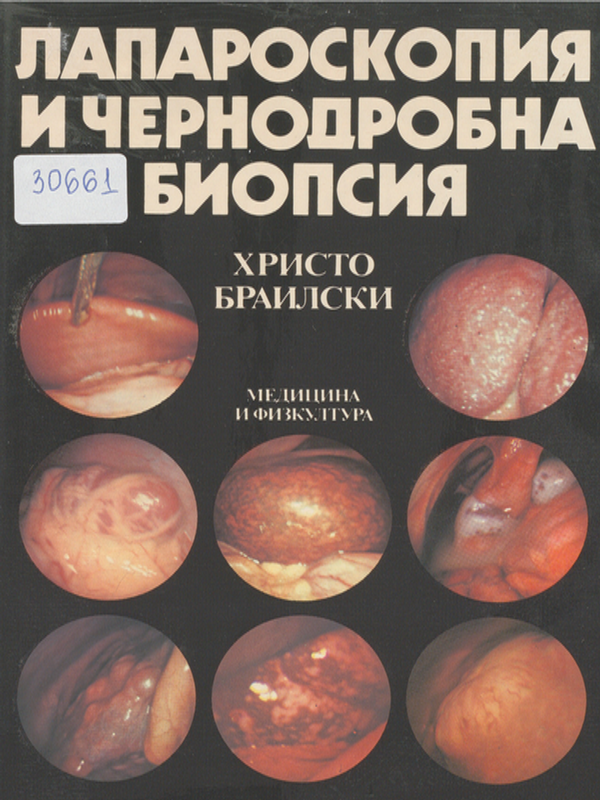 Лапароскопия и чернодробна биопсия