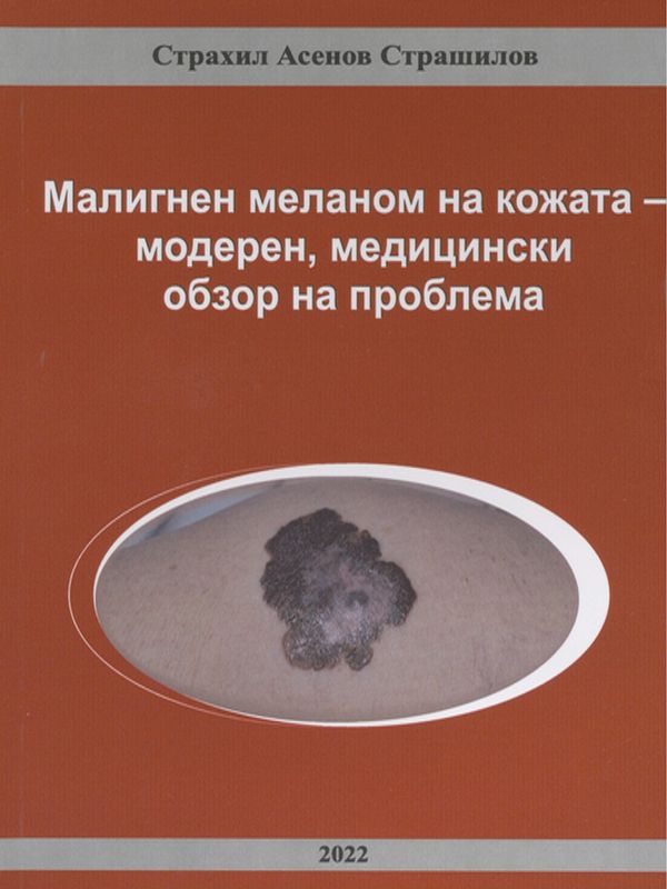 Малигнен меланом на кожата - модерен, медицински обзор на проблема