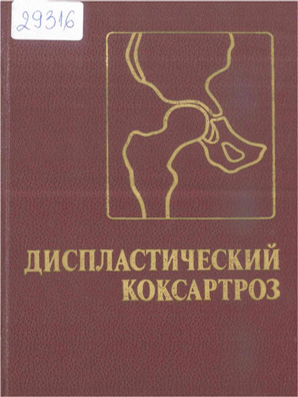 Диспластический коксартроз