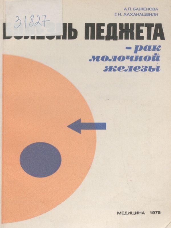 Болезнь Педжета - рак молочной железы