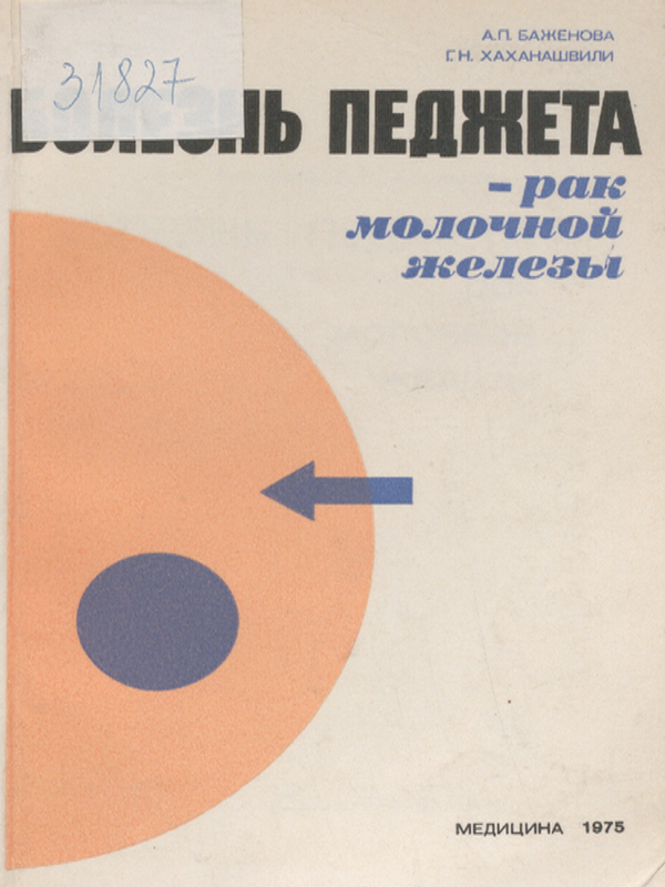 Болезнь Педжета - рак молочной железы