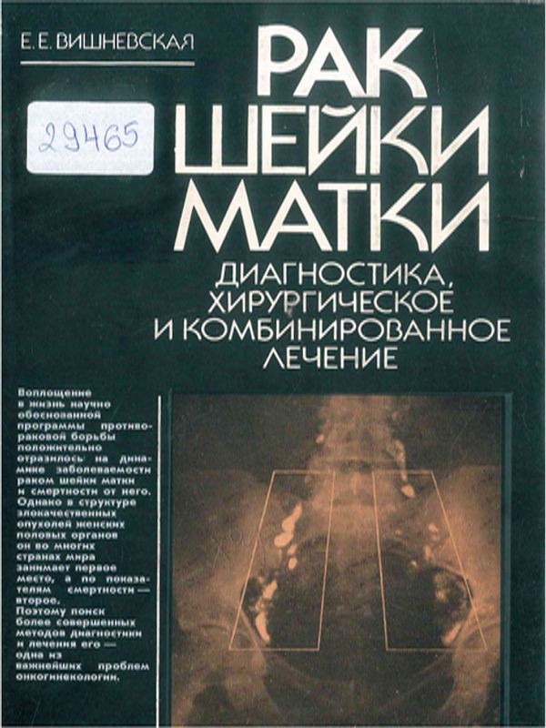 Рак шейки матки