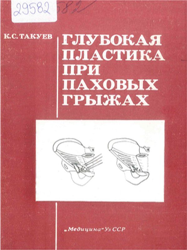 Глубокая пластика при паховых грыжах