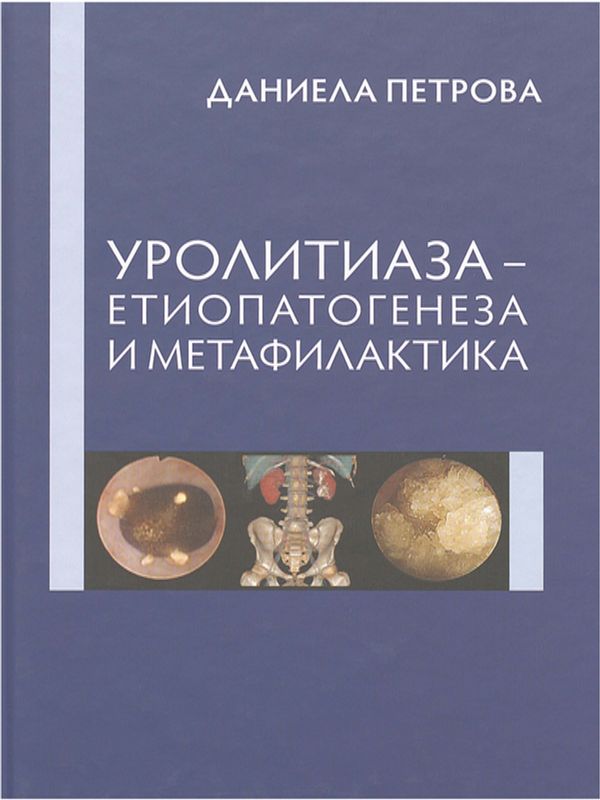 Уролитиаза - етиопатогенеза и метафилактика