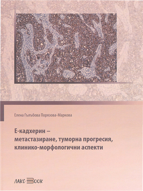 Е-кадхерин - метастазиране, туморна прогресия, клинико-морфологични аспекти