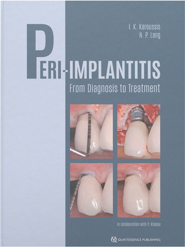 Peri-Implantitis
