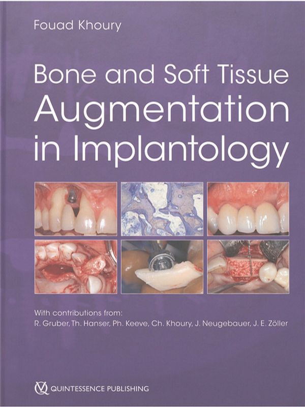 Bone and soft tissue augmentation in implantology