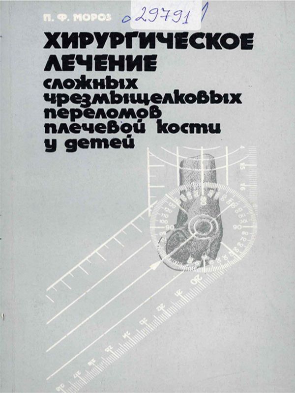 Хирургическое лечение сложных чрезмыщелковых переломов плечевой кости у детей