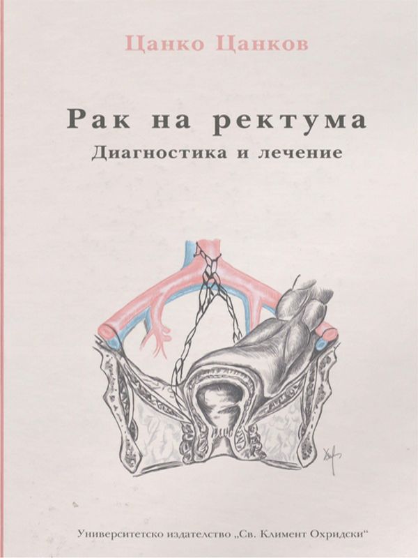 Рак на ректума