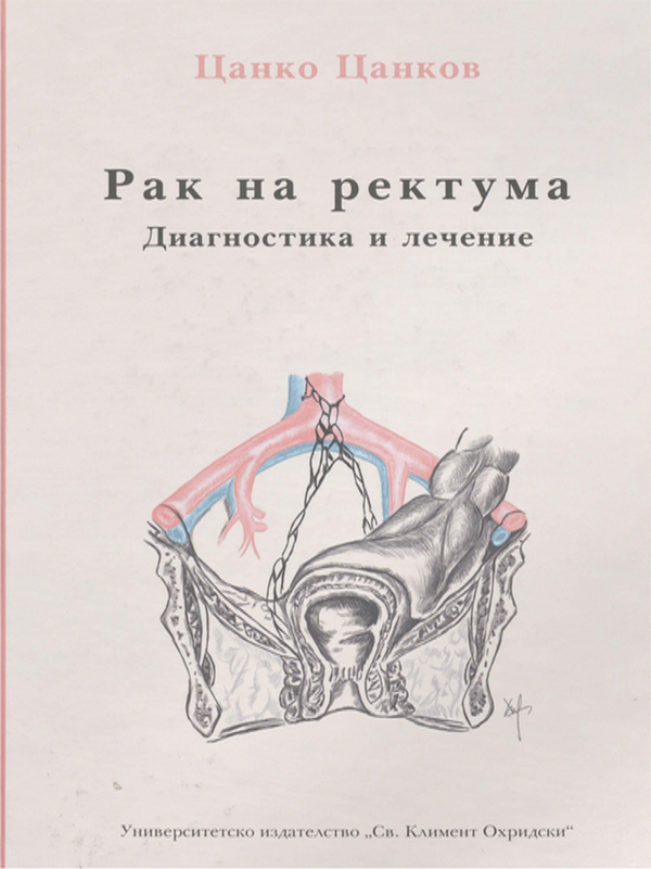 Рак на ректума