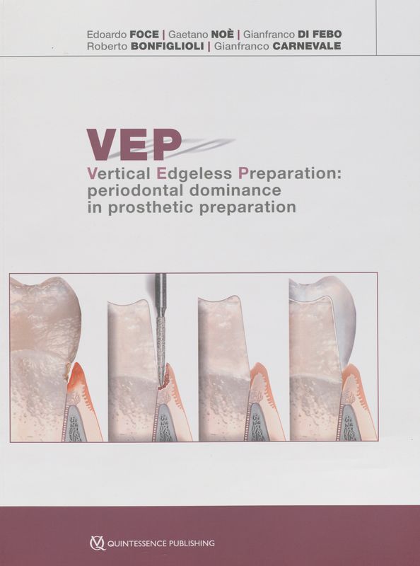 VEP Vertical edgeless preparation: periodontal dominance in prosthetic preparation