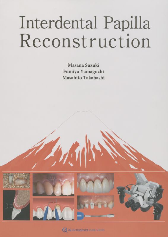 Interdental papilla reconstruction